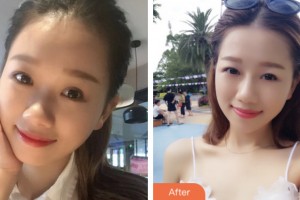 婁底希美醫(yī)療美容門診部騰召勇整形價(jià)格表附隆鼻案例展示