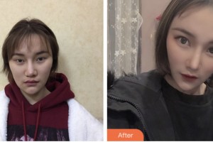 婁底愛(ài)思特醫(yī)療美容醫(yī)院謝勁松整形價(jià)格表附肋軟骨隆鼻案例展示