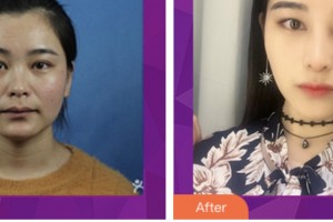 婁底希美醫(yī)療美容門診部汪多整形價(jià)格表附假體隆鼻案例展示