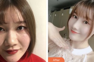 婁底愛(ài)思特醫(yī)療美容醫(yī)院劉珊珊整形價(jià)格表附耳軟骨復(fù)合隆鼻案例展示