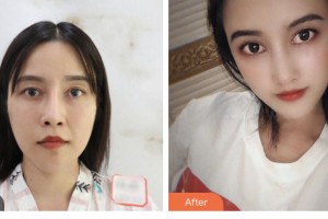 婁底市第一人民醫(yī)院燒傷整形外科周勇整形價(jià)格表附鼻修復(fù)案例展示