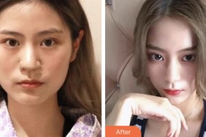 湘潭華雅整形美容醫(yī)院馮潤(rùn)川整形價(jià)格表附鼻部綜合案例展示