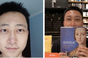 荊門市第一人民醫(yī)院醫(yī)學(xué)美容中心劉艷明整形價格表附種眉毛案例展示