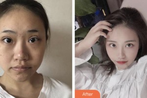 荊門市第一人民醫(yī)院醫(yī)學(xué)美容中心閔峰整形價格表附埋線提升案例展示