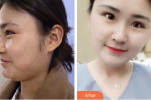 荊門市第一人民醫(yī)院醫(yī)學(xué)美容中心謝和新整形價格表附超聲提拉案例展示