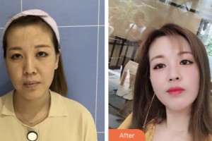 荊門市第二人民醫(yī)院醫(yī)學(xué)整形美容中心金娟娟整形價格表附埋線提升案例展示