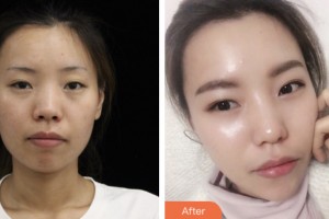 荊門市第二人民醫(yī)院醫(yī)學(xué)整形美容中心王金波整形價格表附熱瑪吉案例展示