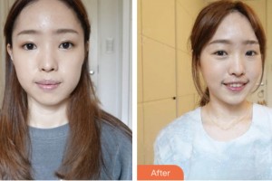 荊門市第二人民醫(yī)院醫(yī)學(xué)整形美容中心李成龍整形價格表附埋線提升案例展示