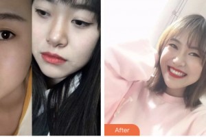 荊門市第一人民醫(yī)院醫(yī)學(xué)美容中心嚴(yán)加林整形價格表附牙齒矯正案例展示