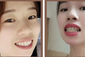 荊門市第二人民醫(yī)院醫(yī)學(xué)整形美容中心葉君整形價格表附冷光美白案例展示