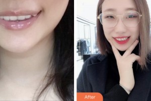 荊門劉永國醫(yī)療美容診所劉永國整形價格表附隱形托槽矯正案例展示