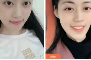 荊門好美醫(yī)療美容醫(yī)院葉華整形價格表附美白貼片案例展示