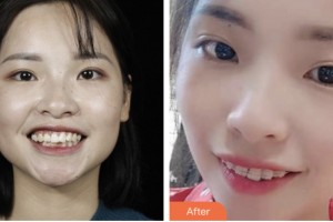 荊門好美醫(yī)療美容醫(yī)院謝鎮(zhèn)安整形價格表附金屬托槽矯正案例展示