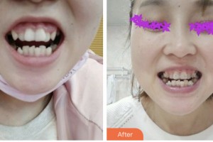 荊門小白兔口腔醫(yī)院趙小康整形價(jià)格表附超聲波潔牙案例展示