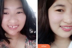 荊門小白兔口腔醫(yī)院李華強(qiáng)整形價(jià)格表附種植牙案例展示