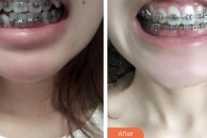 荊門小白兔口腔醫(yī)院全旭整形價(jià)格表附金屬托槽矯正案例展示