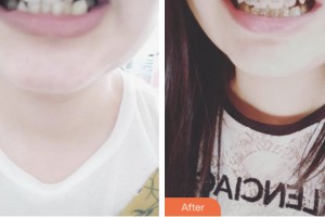 荊門小白兔口腔醫(yī)院張陽整形價(jià)格表附金屬托槽矯正例展示