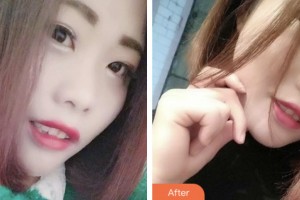 荊門小白兔口腔醫(yī)院伍愛民整形價(jià)格表附超聲波潔牙案例展示