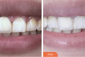 荊門小白兔口腔醫(yī)院李媛整形價(jià)格表附超聲波潔牙案例展示