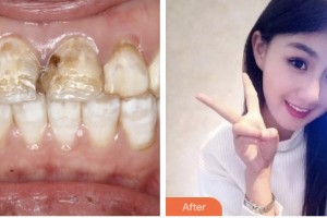 荊門小白兔口腔醫(yī)院易君整形價(jià)格表附超聲波潔牙案例展示