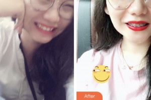 荊門市口腔醫(yī)院鄒廷前整形價(jià)格表附金屬托槽矯正案例展示