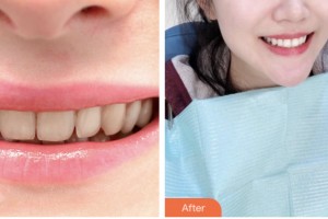 荊門市口腔醫(yī)院官瑩玉整形價(jià)格表附冷光美白案例展示