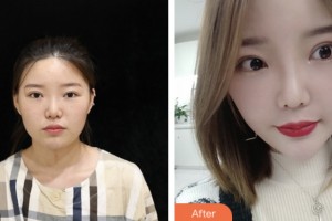 株洲嘉美醫(yī)療整形美容診所李明柱整形價(jià)格表附鼻部綜合案例展示