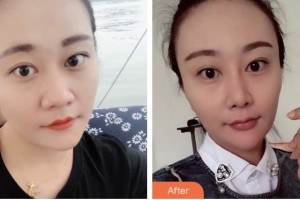 株洲三三一周醫(yī)生整形美容診所周建屏整形價(jià)格表附鼻部綜合案例展示