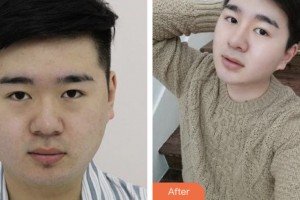 株洲藝佳醫(yī)療美容?？漆t(yī)院李文軍整形價(jià)格表附假體隆鼻案例展示