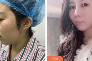 株洲中雅醫(yī)療美容門診部陳瑜整形價(jià)格表附耳軟骨復(fù)合隆鼻案例展示