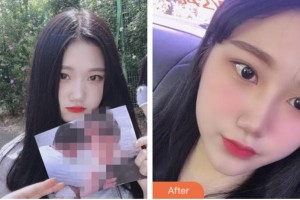 株洲藝佳醫(yī)療美容專科醫(yī)院高謝輝整形價(jià)格表附耳軟骨復(fù)合隆鼻案例展示