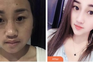 株洲市一醫(yī)院燒傷整形外科蘇開(kāi)新整形價(jià)格表附鼻部綜合案例展示