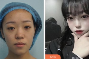 株洲中雅醫(yī)療美容門診部滕召勇整形價(jià)格表附墊鼻基底案例展示