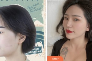 株洲嘉美醫(yī)療整形美容診所賀建湘整形價(jià)格表附鼻部綜合案例展示