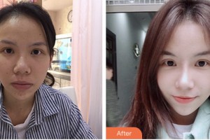 株洲市中心醫(yī)院整形美容科方玉蓉整形價(jià)格表附鼻修復(fù)案例展示