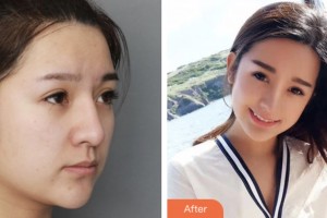 株洲市中心醫(yī)院整形美容科黃江山整形價(jià)格表附鼻部綜合案例展示