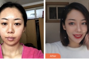 株洲市中心醫(yī)院整形美容科譚朝中整形價(jià)格表附鼻部綜合案例展示