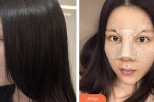 株洲市中心醫(yī)院整形美容科王志強(qiáng)整形價(jià)格表附墊鼻基底案例展示