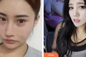 株洲愛思特醫(yī)療美容醫(yī)院林秀青整形價(jià)格表附鼻部綜合案例展示