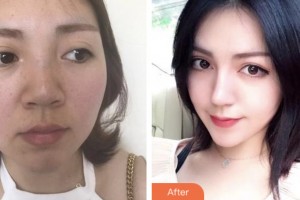 株洲市中心醫(yī)院整形美容科張?jiān)迫A整形價(jià)格表附鼻部綜合案例展示