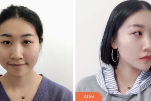 株洲宇芳姬醫(yī)療美容門診部劉明星整形價(jià)格表附鼻部綜合案例展示
