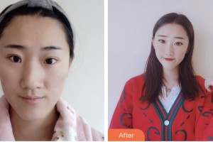 株洲雅美醫(yī)療美容門診部黃益卯整形價(jià)格表附鼻部綜合案例展示