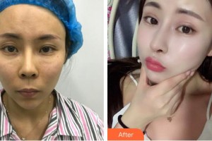株洲雅美醫(yī)療美容門診部車旺整形價格表附鼻修復案例展示