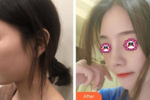 株洲愛爾眼科醫(yī)院尹泳紅整形價格表附肋軟骨隆鼻案例展示