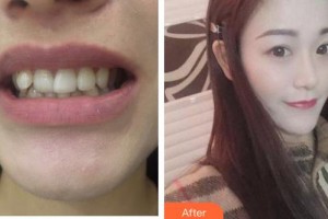 泰州麗都醫(yī)療美容醫(yī)院蔣自強(qiáng)整形價(jià)格表附牙齒隱形矯正案例展示