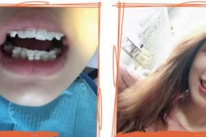 泰州市人民醫(yī)院燒傷整形科李羅珠整形價(jià)格表附牙貼面案例展示