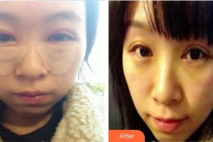 泰州市人民醫(yī)院燒傷整形科孫步梅整形價(jià)格表附外切祛眼袋案例展示