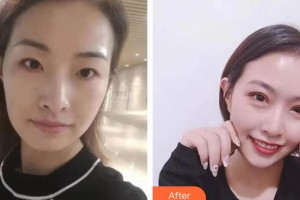 泰州張勤眼科醫(yī)院醫(yī)療美容中心張勤整形價(jià)格表附眼部綜合案例展示