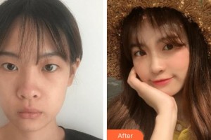 泰州張勤眼科醫(yī)院醫(yī)療美容中心耿瑞整形價(jià)格表附切開雙眼皮案例展示