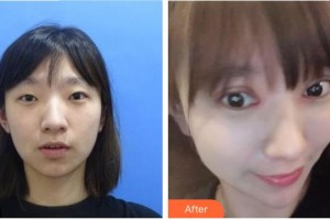 泰州市人民醫(yī)院燒傷整形科陳傳俊整形價(jià)格表附眼部綜合案例展示